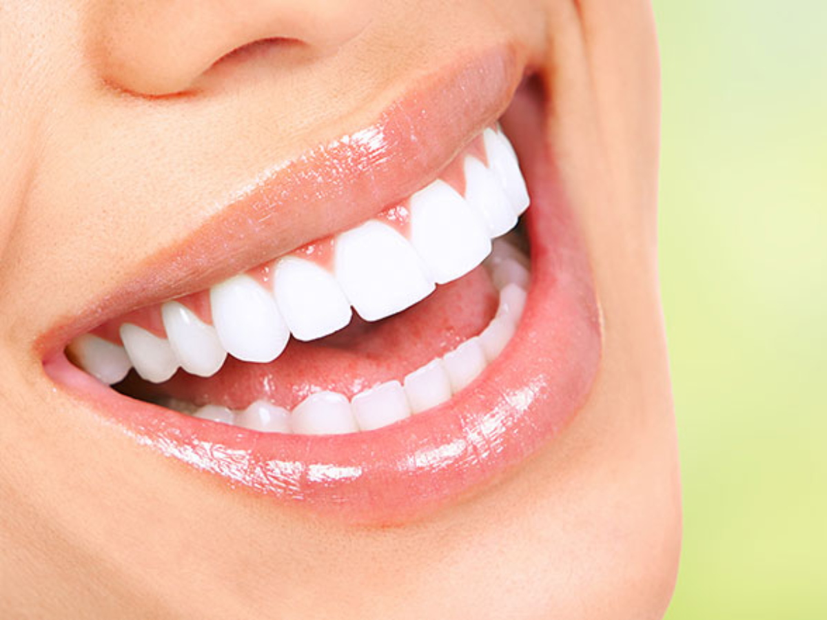Clareamento dental: o que você precisa saber antes de fazer o seu