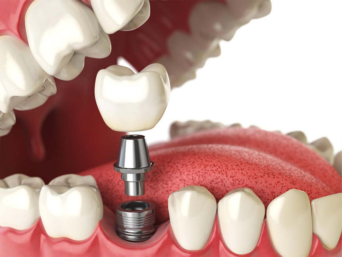 Implante ou Prótese Dentária: qual é a melhor opção para o seu caso?